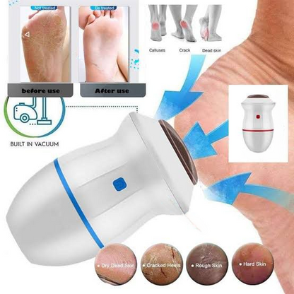 Electric Back Callus Remover with Vacuum – Rechargeable Foot Grinder for Dead Skin & Cracked Heels
